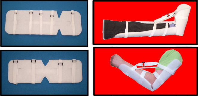 Ankles and Elbows Splint
